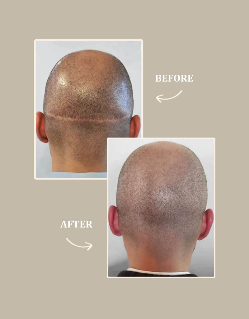 Scalp Micropigmentation (SMP) to camouflaging with hair fibers or dermal fillers