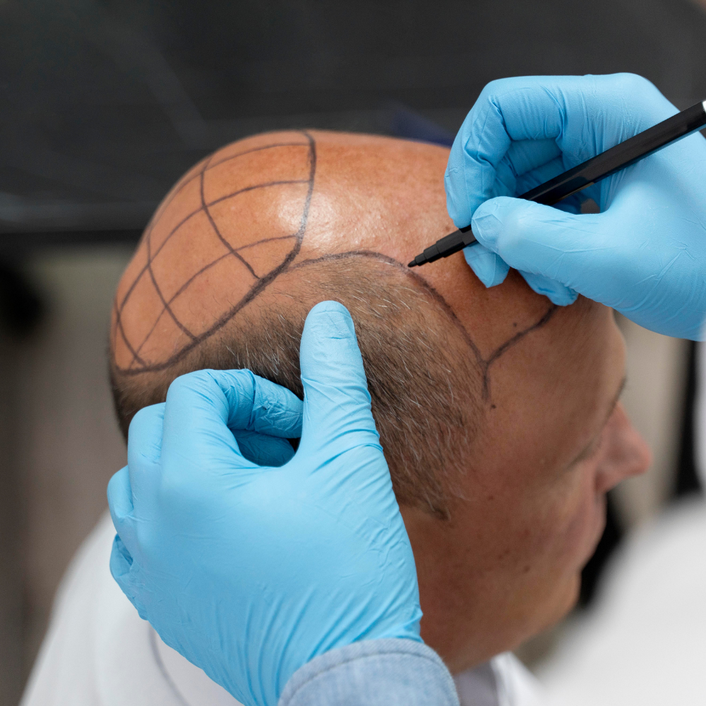 Scalp Micropigmentation