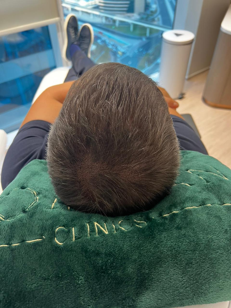 Male hair loss treatment results Dubai