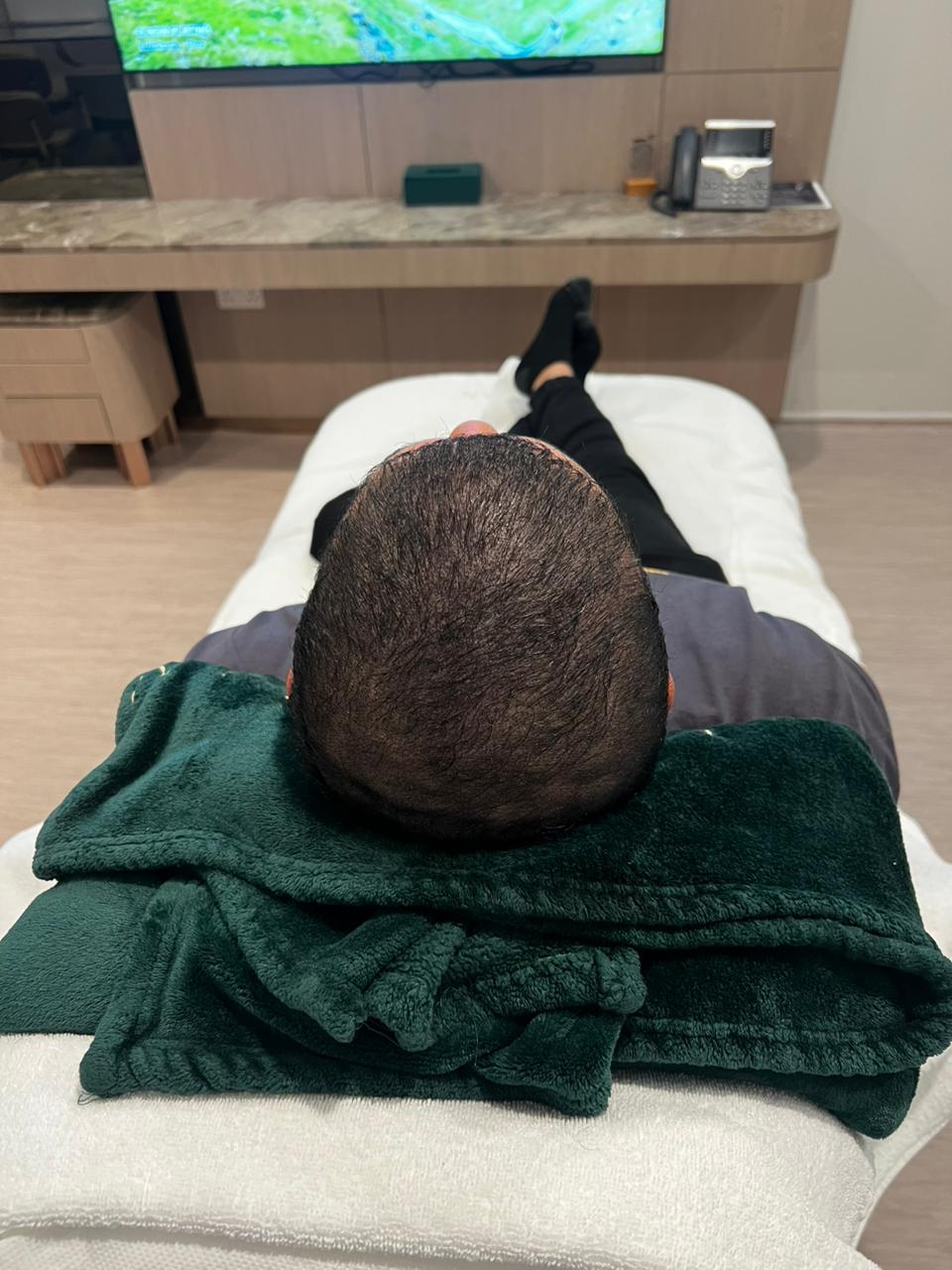 Hair restoration results Dubai