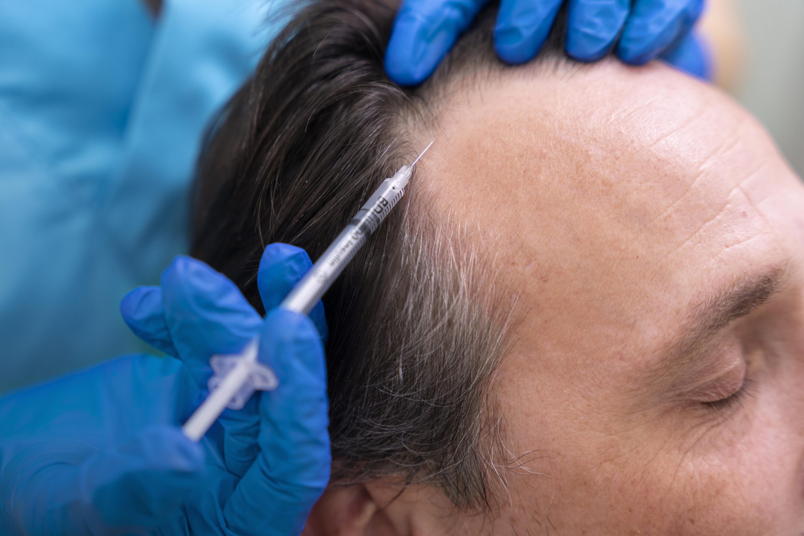 PRP Therapy at Hortman Clinic Dubai
