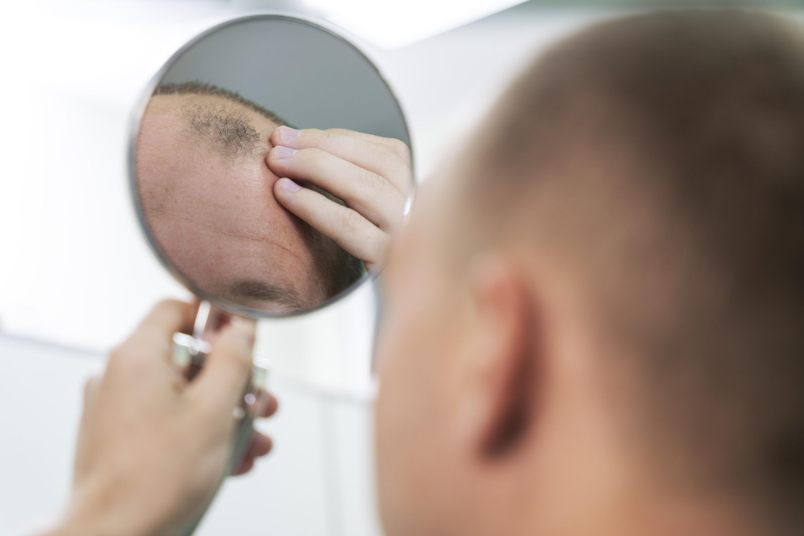 Androgenetic alopecia patient