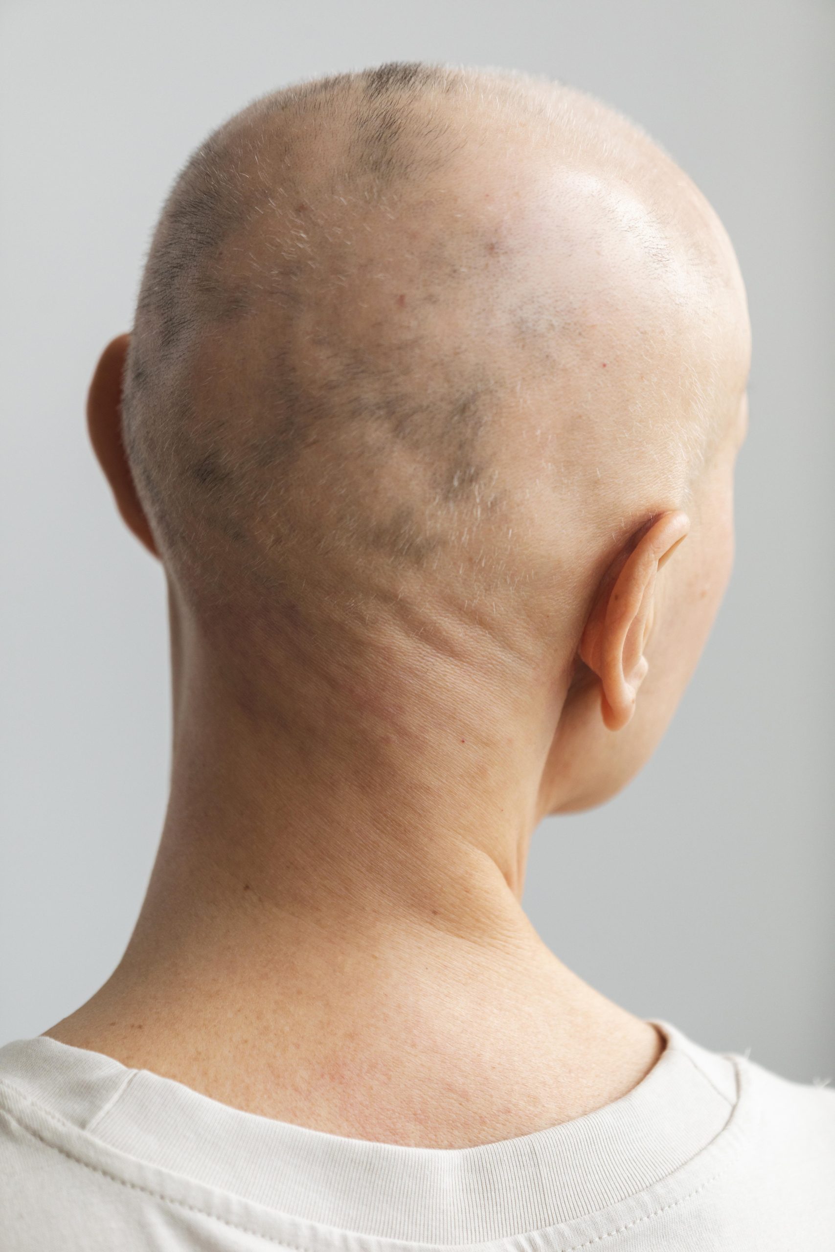 Alopecia areata trichoscopy