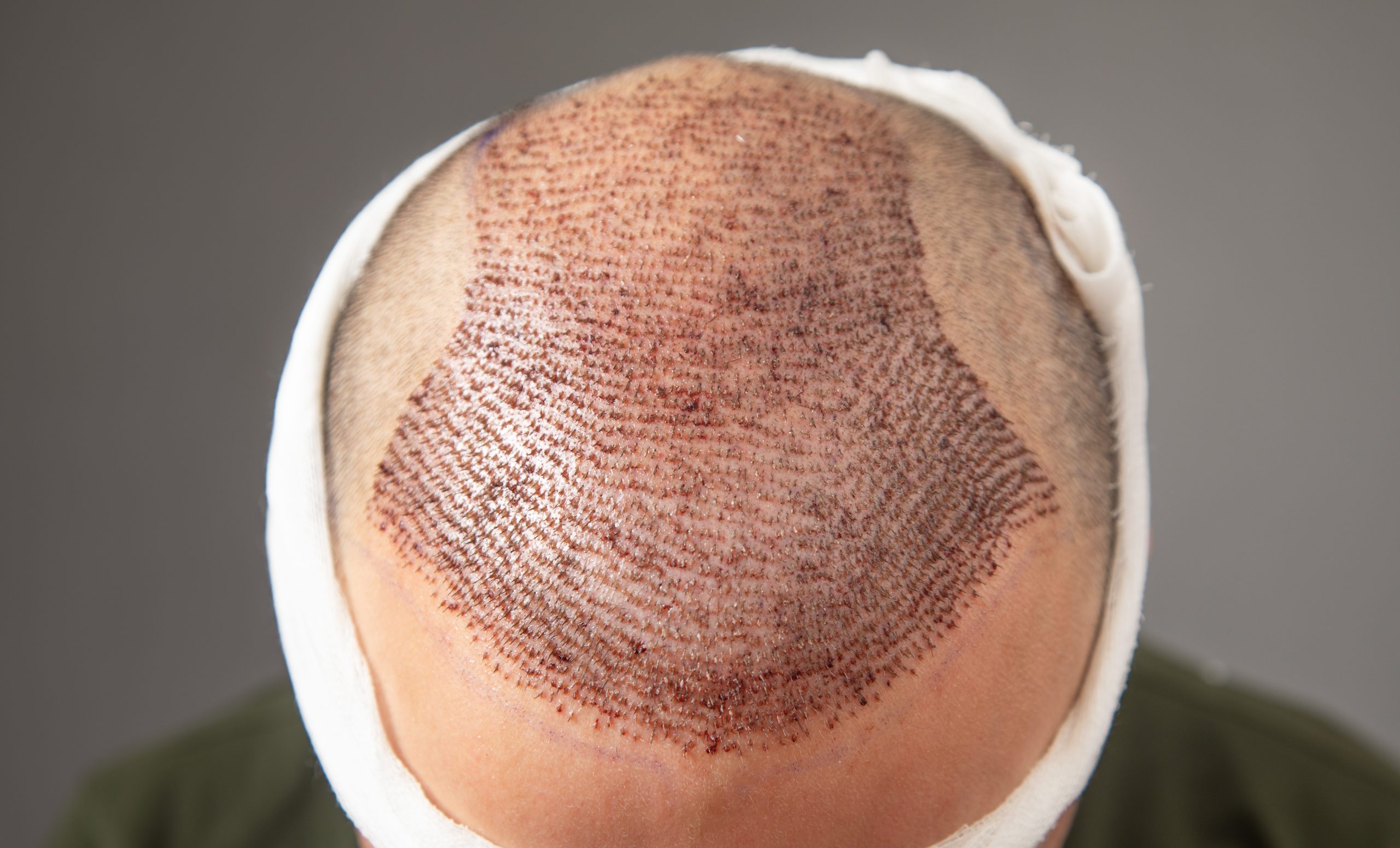 SMP result at Hortman Clinic