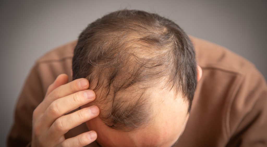 Hair Loss Treatment for Men Dubai