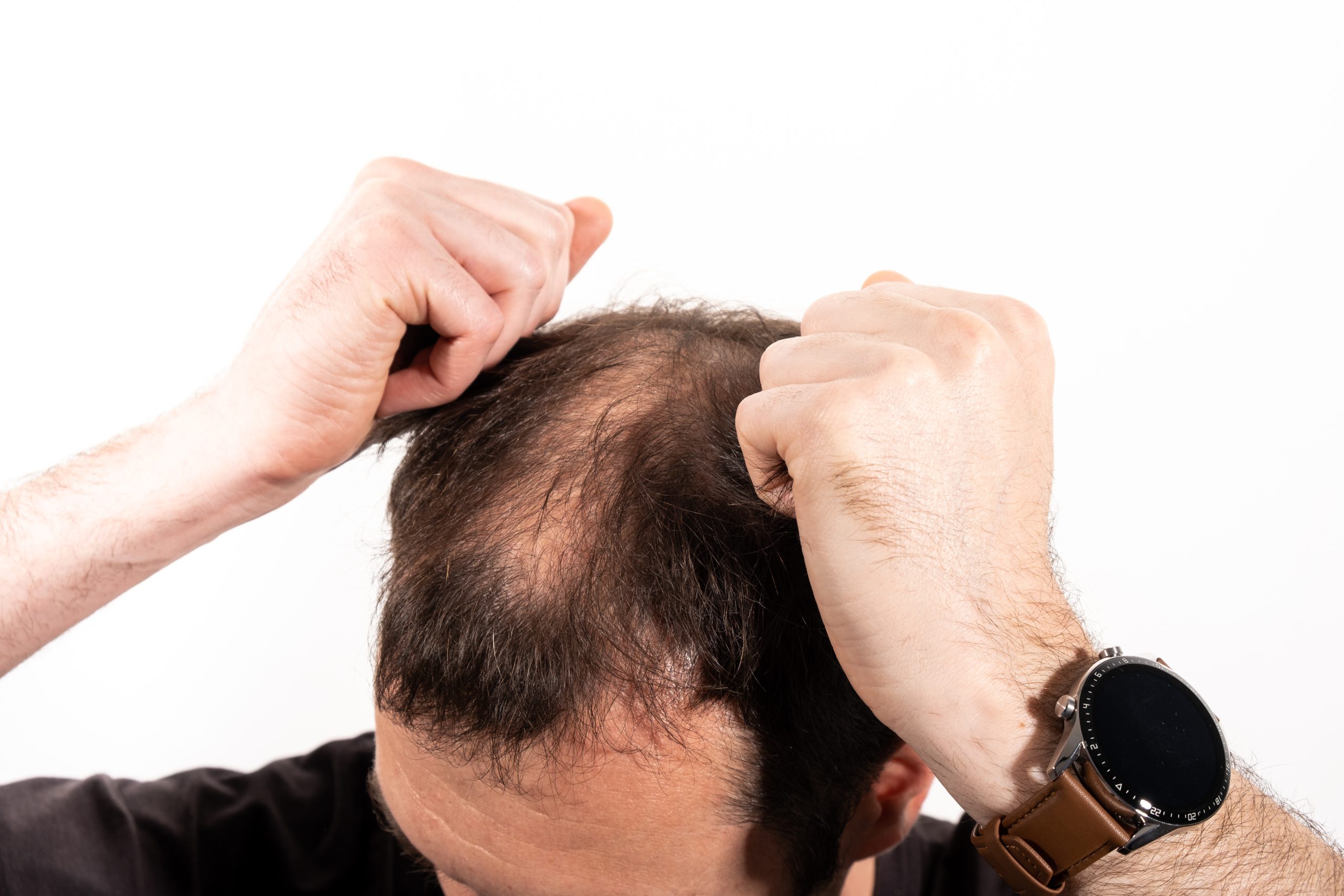 Hair thinning and miniaturisation Dubai