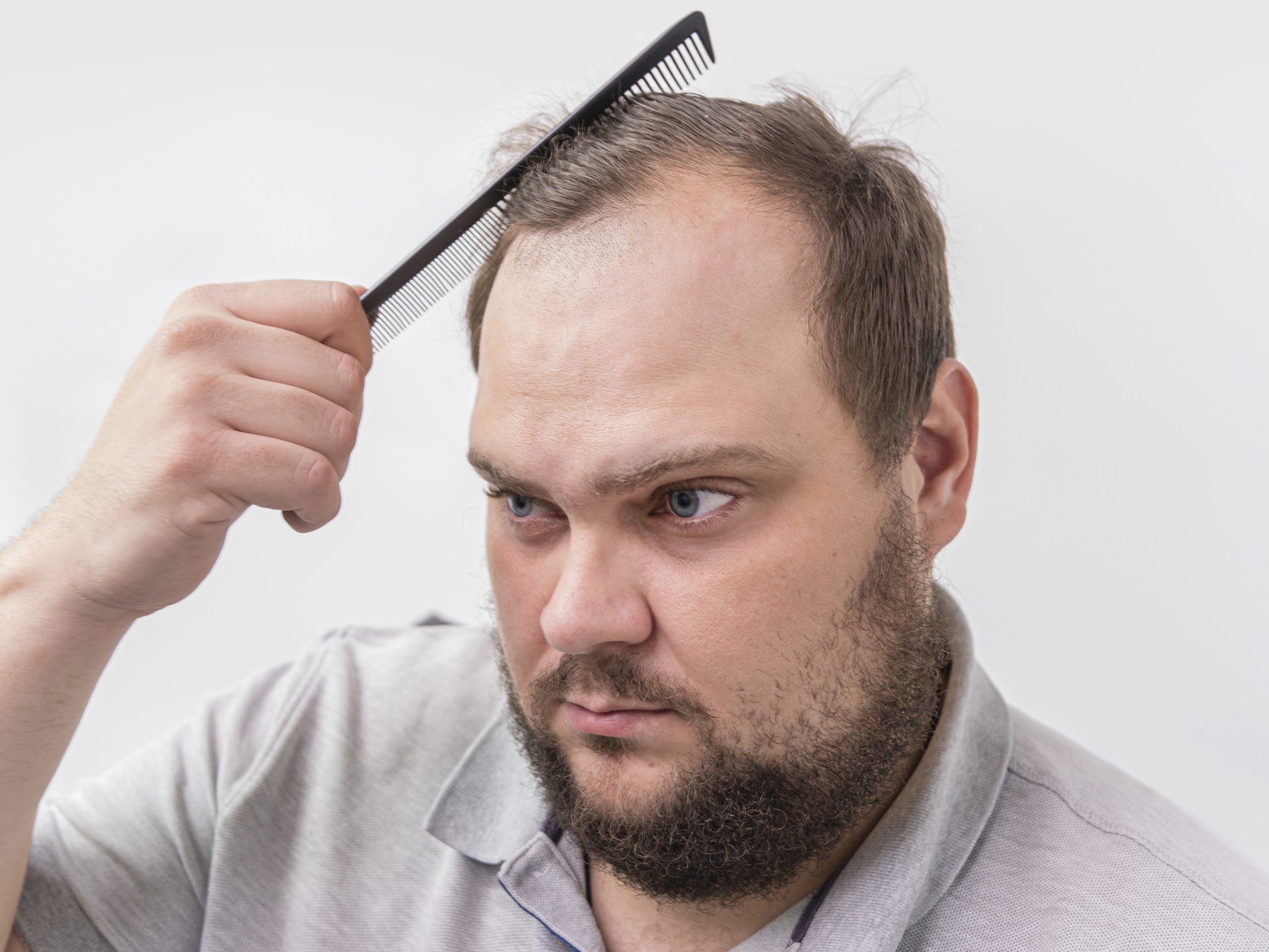 Hair loss in men Dubai