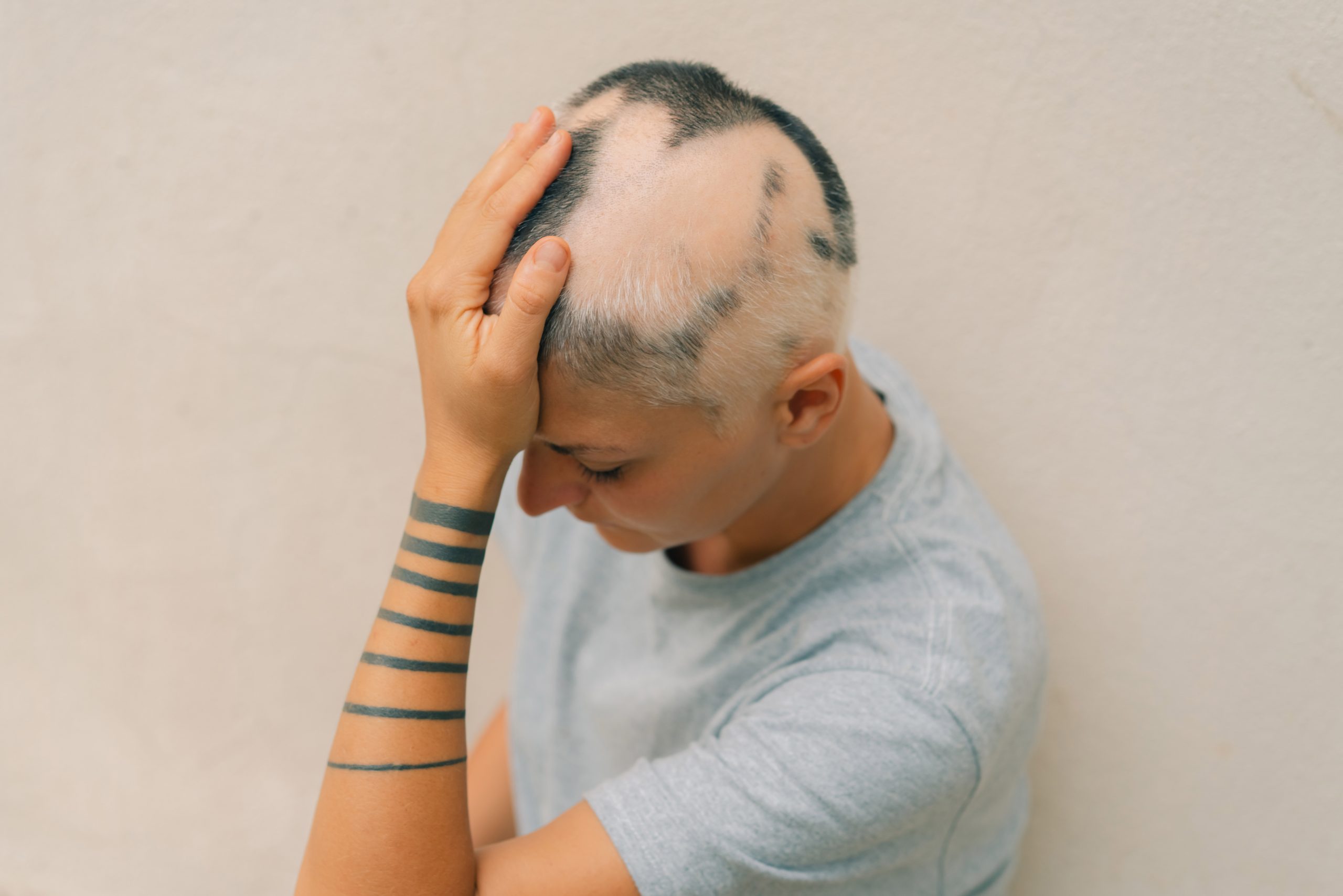 Alopecia areata Dubai