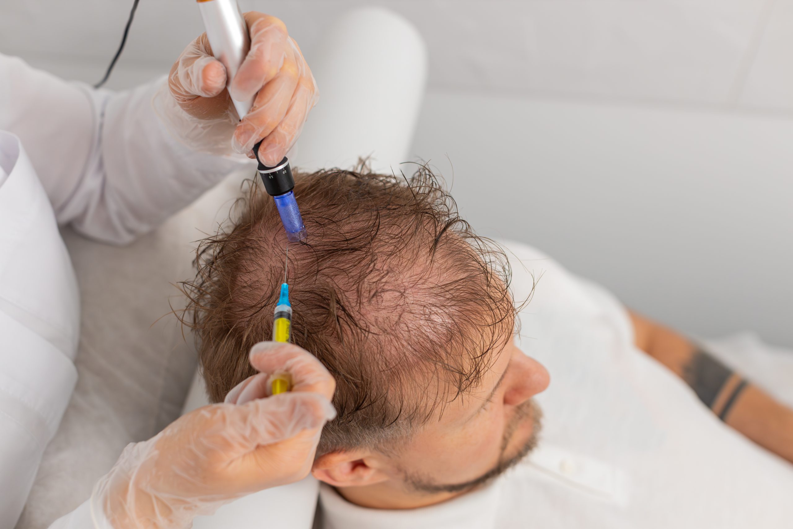 Male hair loss trichoscopy
