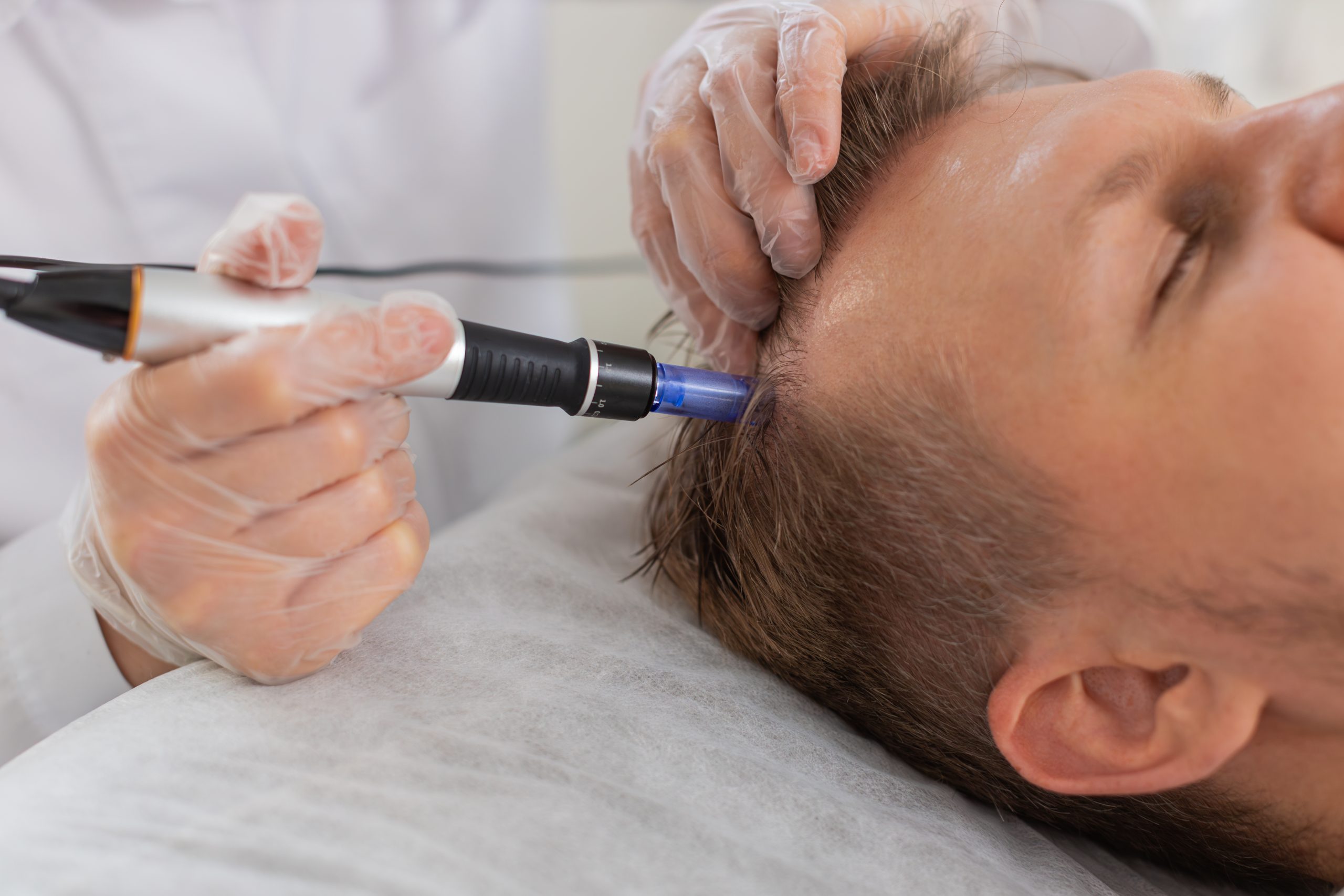Trichoscopy for male hair loss