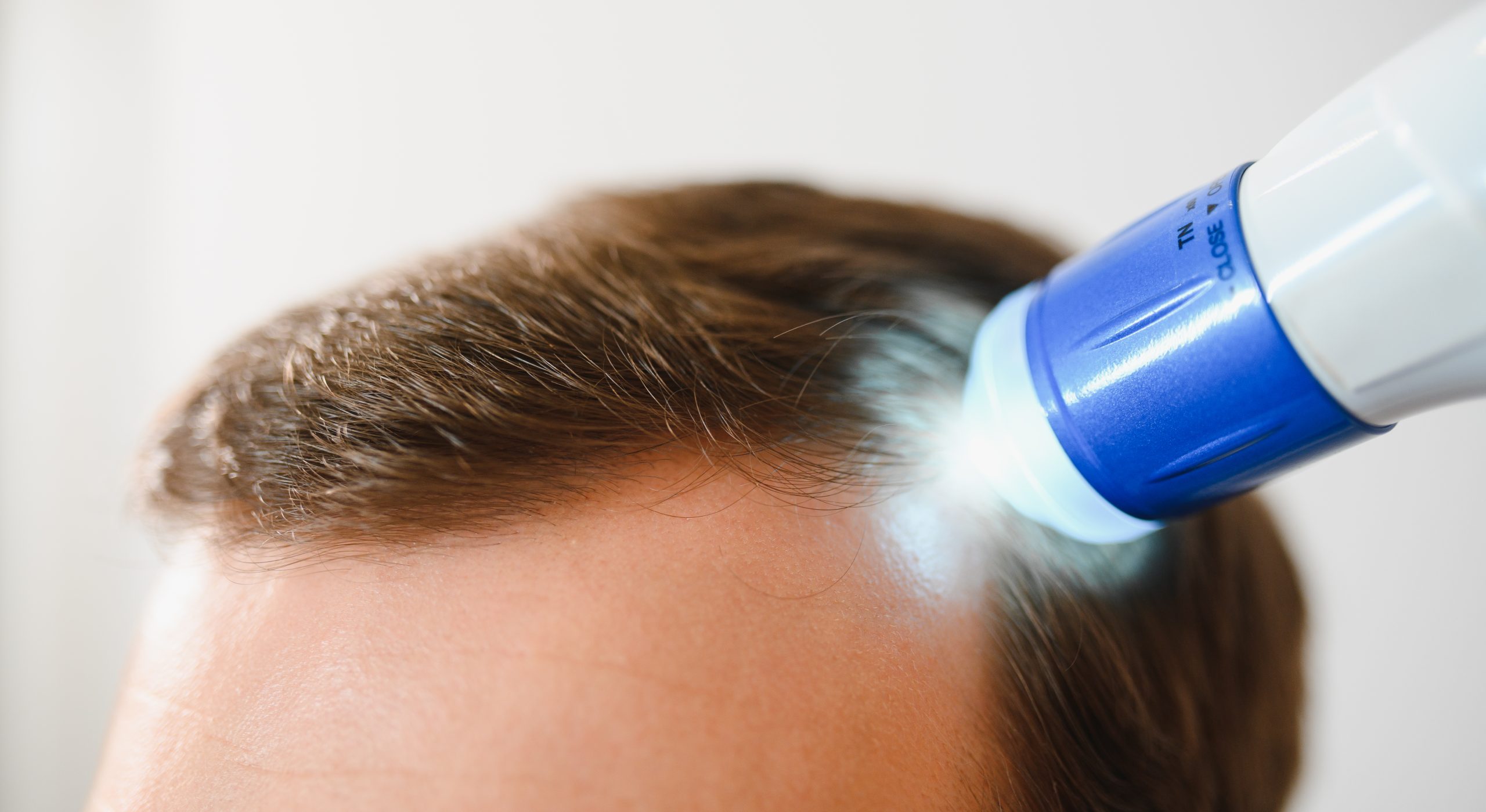 Male pattern hair loss Dubai