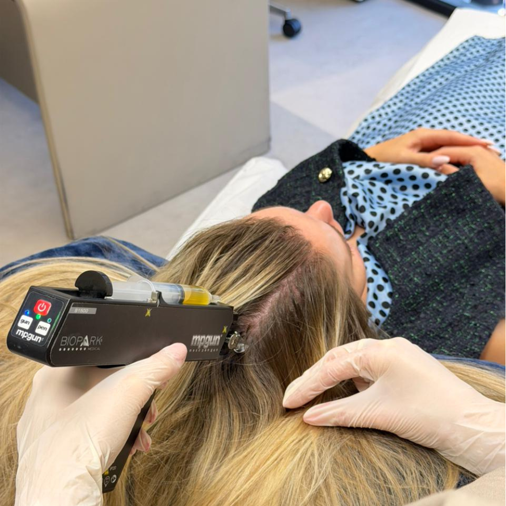 Scalp Micropigmentation at Hortman Clinic Dubai